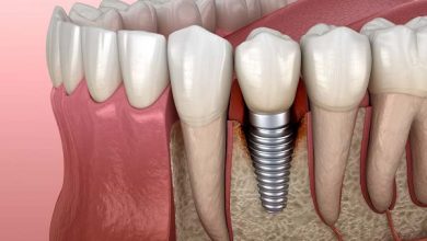 Czym jest periimplantitis? Pielęgnacja implantów laserem stomatologicznym