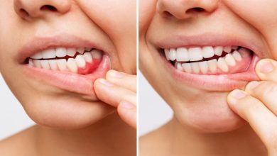 Tonsillektomia zwiększa ryzyko rozwoju periodontitis?